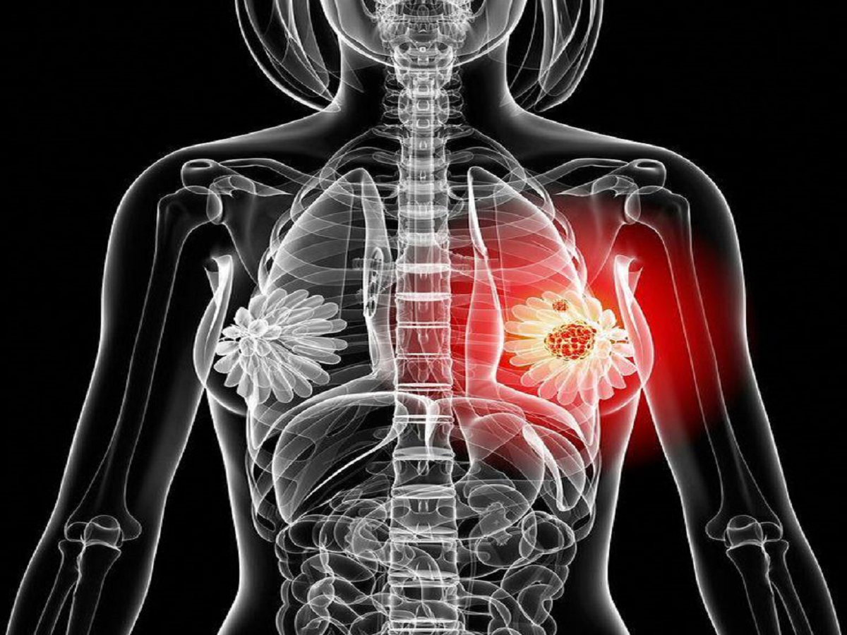 7 Sign of Breast Cancer- अगर आपको भी हैं ये 7 ब्रेस्ट कैंसर के लक्षण, तो हो जाइए सावधान - Photo Gallery