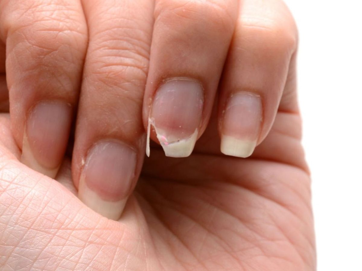 White Spot Meaning: नाखूनों पर सफेद दाग-धब्बे दिखने के पीछे क्या कारण होते है? - Photo Gallery