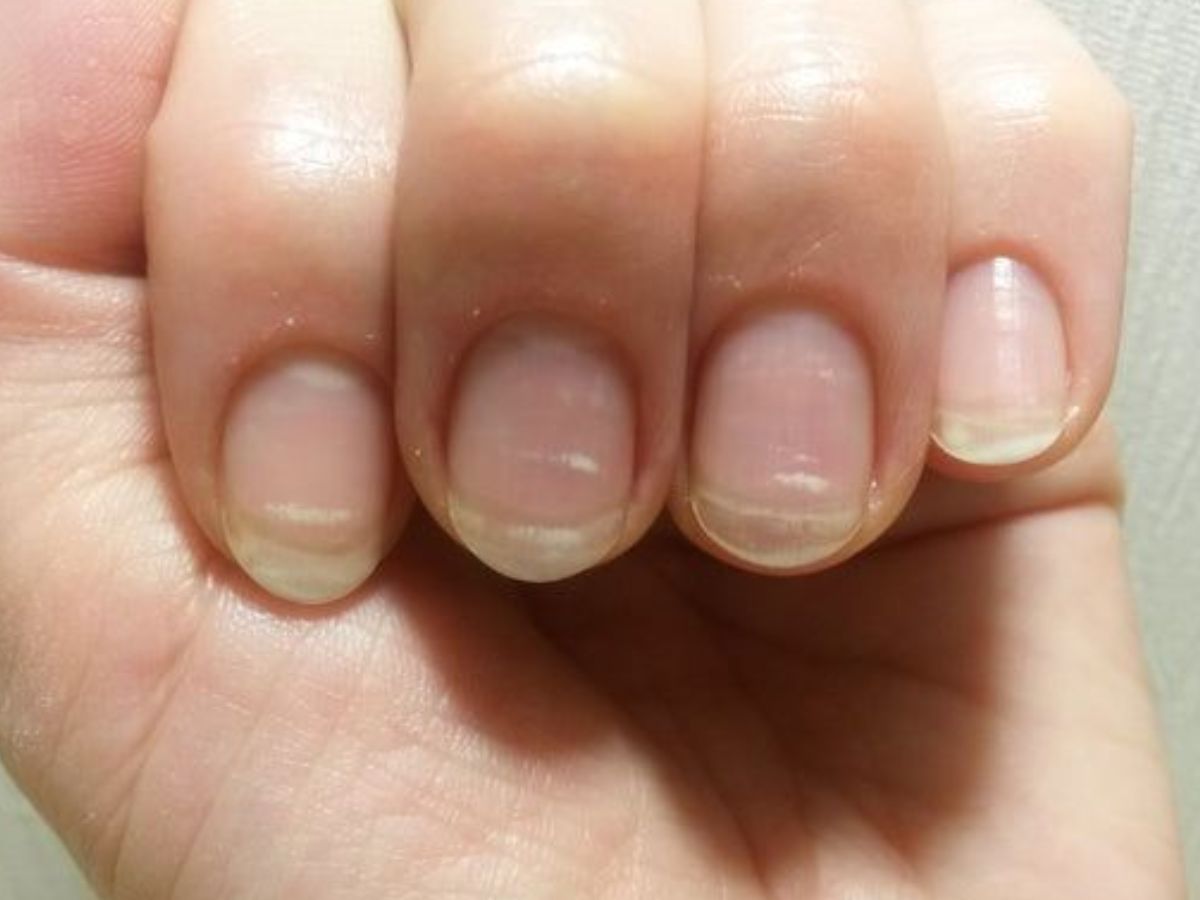 White Spot Meaning: नाखूनों पर सफेद दाग-धब्बे दिखने के पीछे क्या कारण होते है? - Photo Gallery