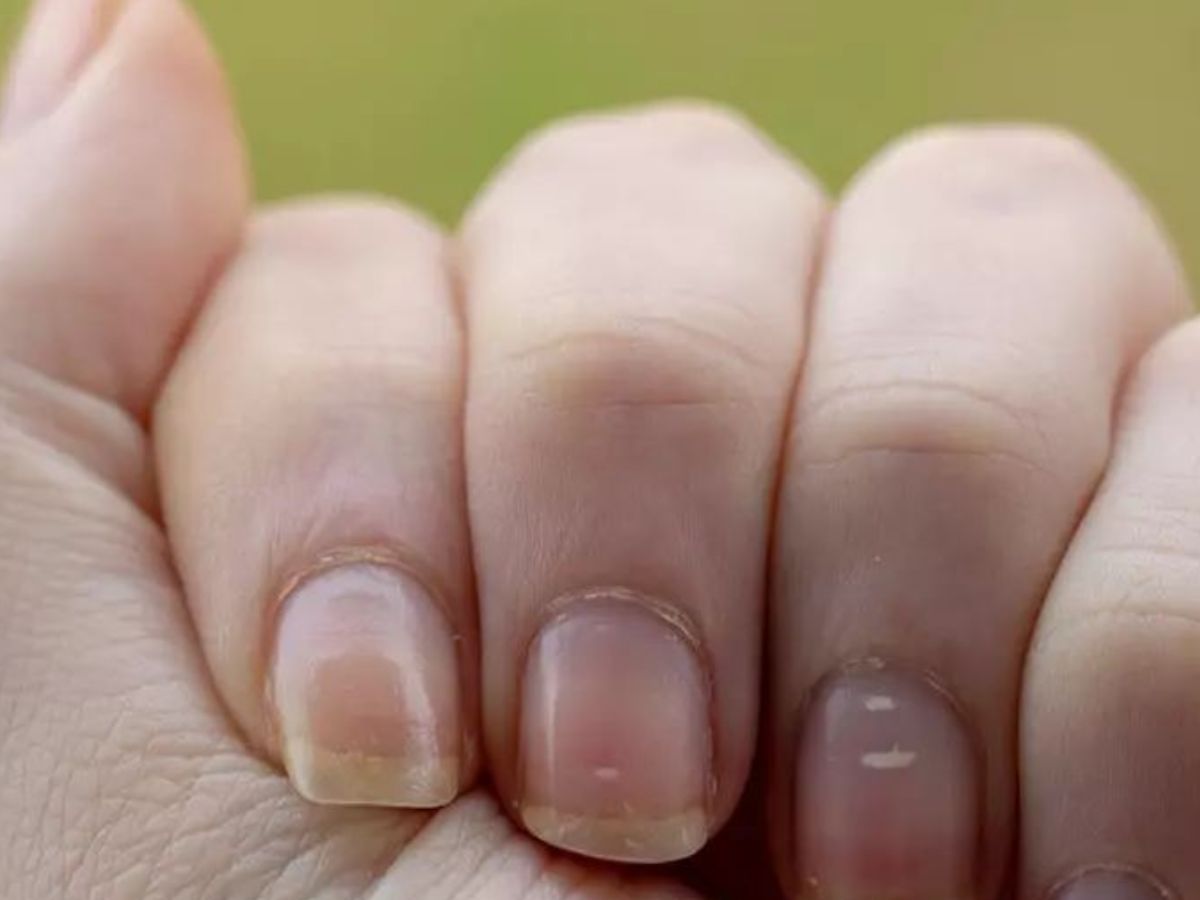 White Spot Meaning: नाखूनों पर सफेद दाग-धब्बे दिखने के पीछे क्या कारण होते है? - Photo Gallery