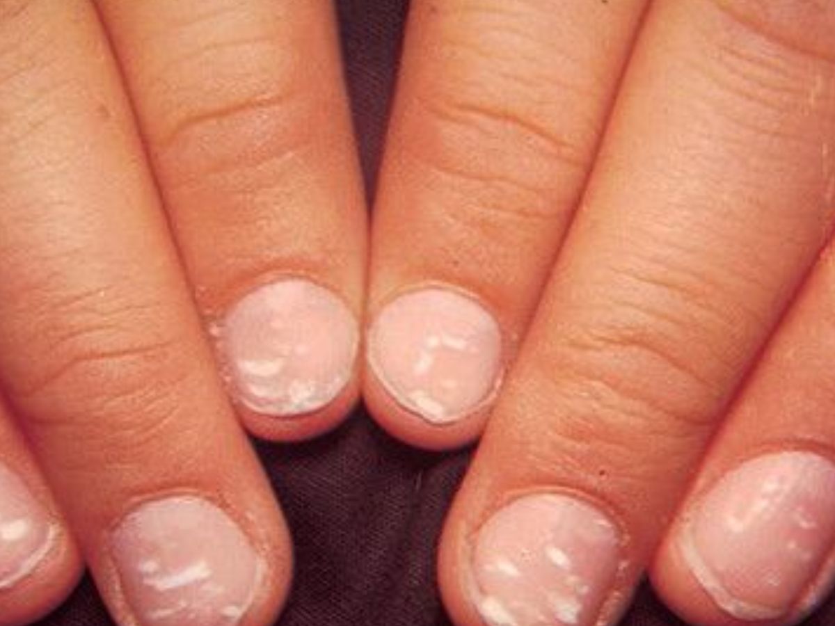 White Spot Meaning: नाखूनों पर सफेद दाग-धब्बे दिखने के पीछे क्या कारण होते है? - Photo Gallery