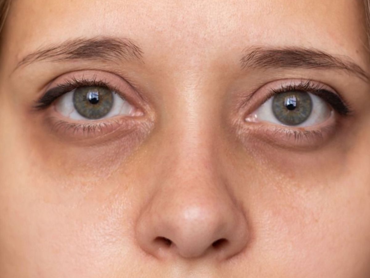 Signs That You Don’t Get Enough Sleep: समय से नींद पूरी नहीं हो पाने से आपको भी हो सकते हैं आंखों के नीचे काले घेरे - Photo Gallery