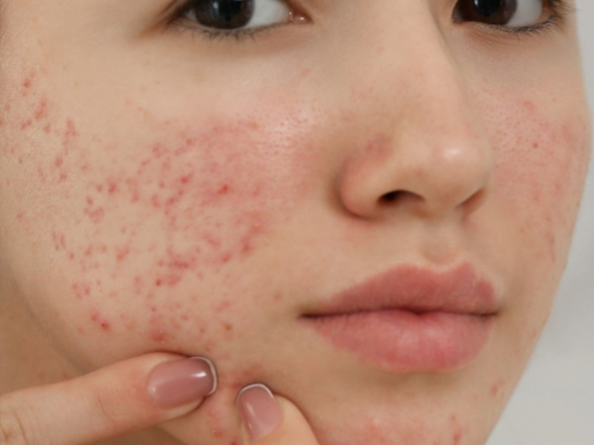 Disadvantages Of Contraceptive Pills:कांट्रेसेप्टिव पिल्स  के नुकसान,जिससे आपकी बॉडी पर हो सकते है ये सारे इफेक्ट - Photo Gallery