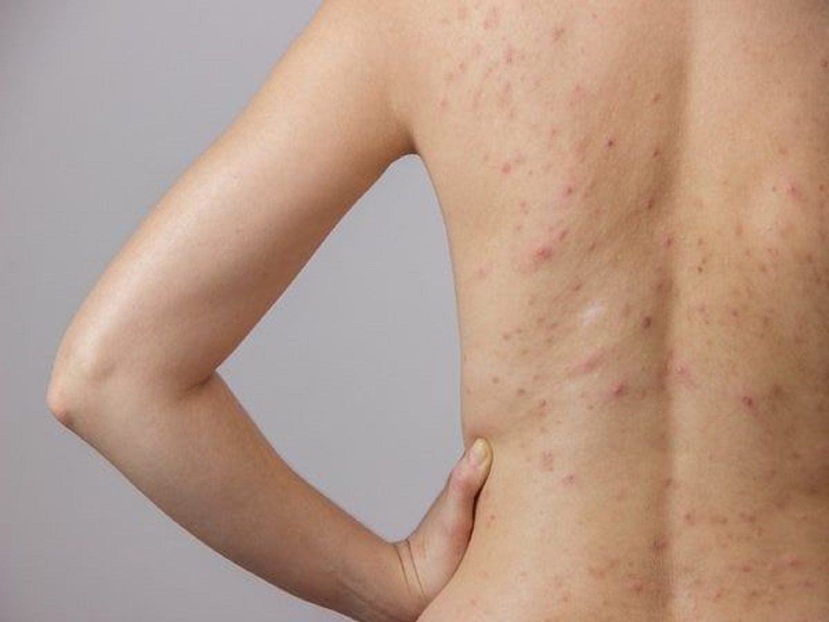Chikungunya Symptoms: बरसात में क्यों बढ़ जाता है चिकनगुनिया? जानिए लक्षण और उपाय - Photo Gallery