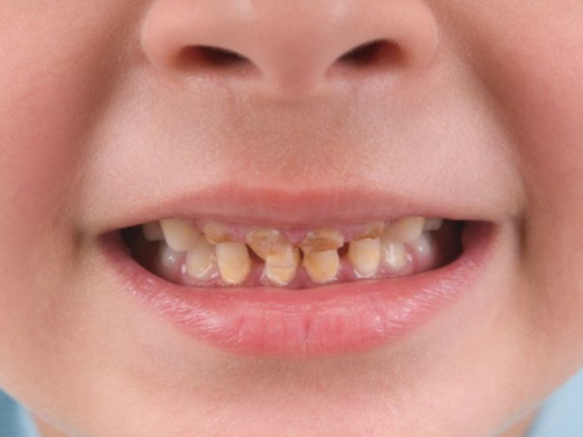 Disadvantages Of Soft Drinks: दांतों के सड़ने से लेकर हड्डियों तक को कमजोर कर सकती है रोजाना सॉफ्ट ड्रिंक पीने की आदत - Photo Gallery