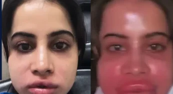 18 की उम्र में करवाया था लिप फिलर अब हटवाकर पछता रहीं Uorfi Javed, होठों का सूज कर हुआ बुरा हाल…चीख-चीख कर लोगों को बता रहीं एक्ट्रेस