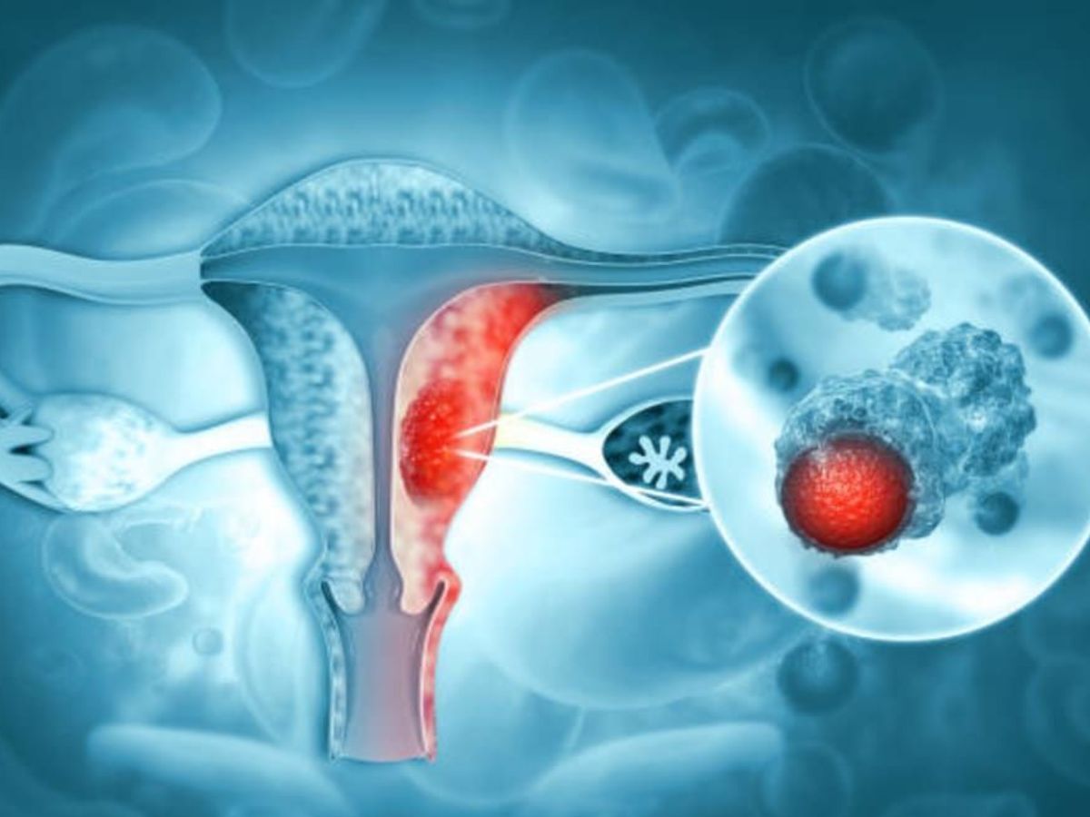 सर्वाइकल कैंसर से बचाव के लिए हर महिला ये कुछ कदम जरूर उठाएं - Photo Gallery