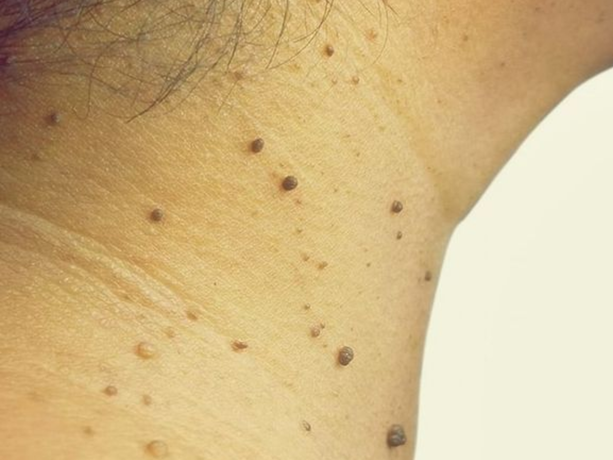 Due to the human papillomavirus - Photo Gallery