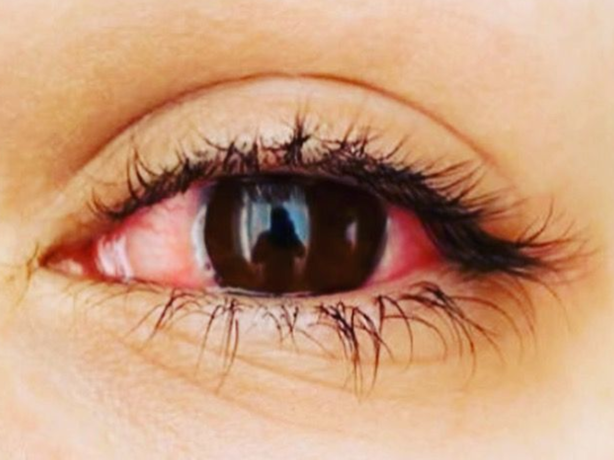 Increased risk of infection - Photo Gallery