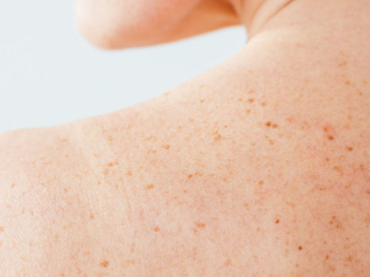 क्या आपके भी शरीर पर है मस्से का भंडार? तो हो जाइए सावधान, नहीं तो आप भी हो सकते हैं जानलेवा बीमारियों का शिकार - Photo Gallery