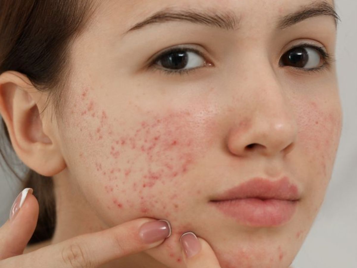 Helpful in reducing acne - Photo Gallery