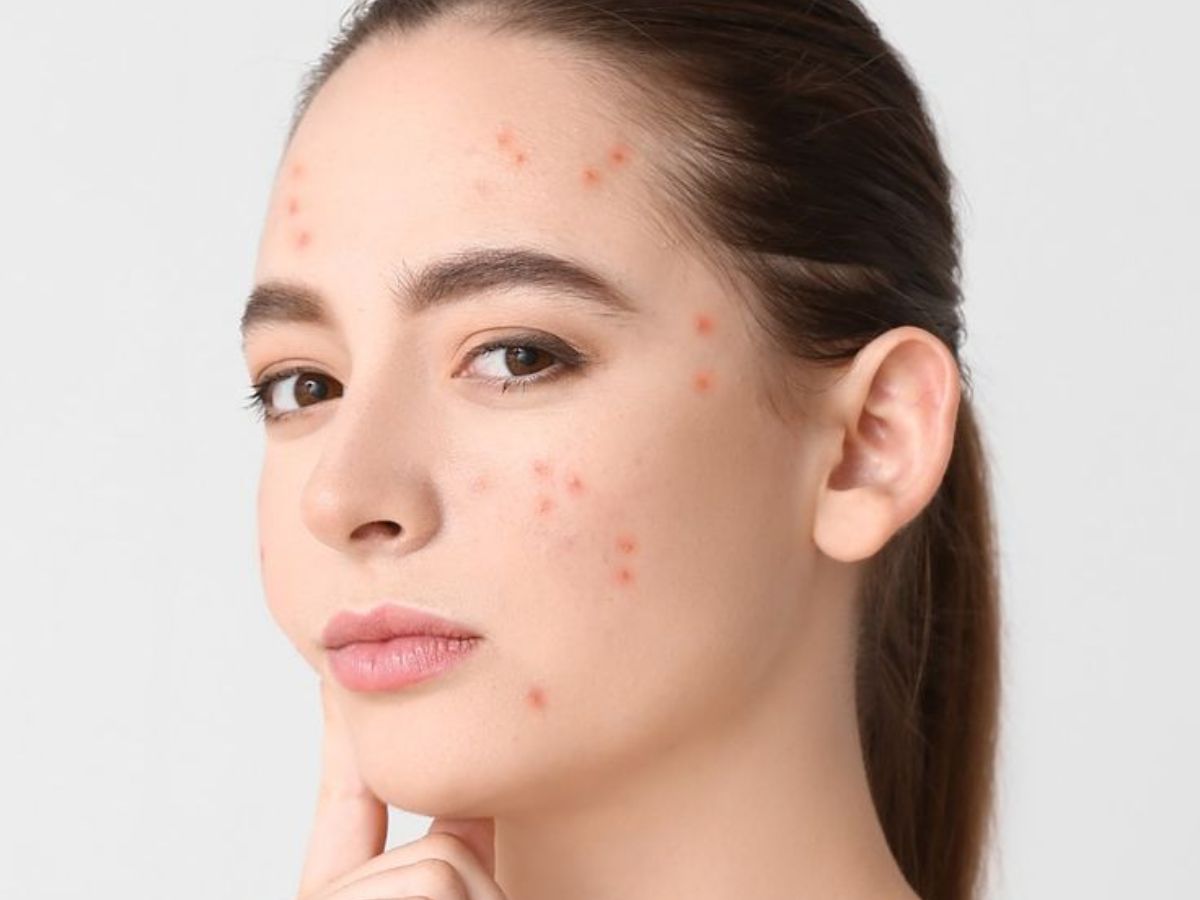 क्या सचमुच बासी थूक से ठीक होते हैं पिंपल्स? जाने Tamannaah Bhatia के स्किन हैक की सच्चाई - Photo Gallery