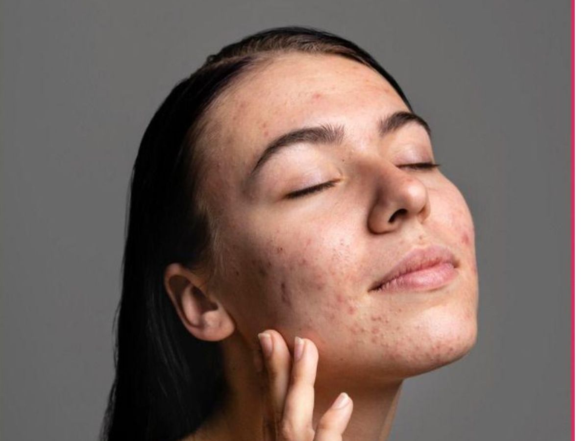 क्या सचमुच बासी थूक से ठीक होते हैं पिंपल्स? जाने Tamannaah Bhatia के स्किन हैक की सच्चाई - Photo Gallery