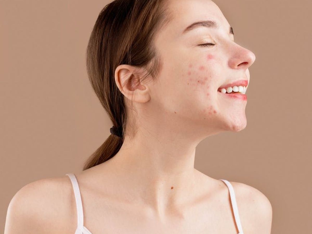 क्या सचमुच बासी थूक से ठीक होते हैं पिंपल्स? जाने Tamannaah Bhatia के स्किन हैक की सच्चाई - Photo Gallery