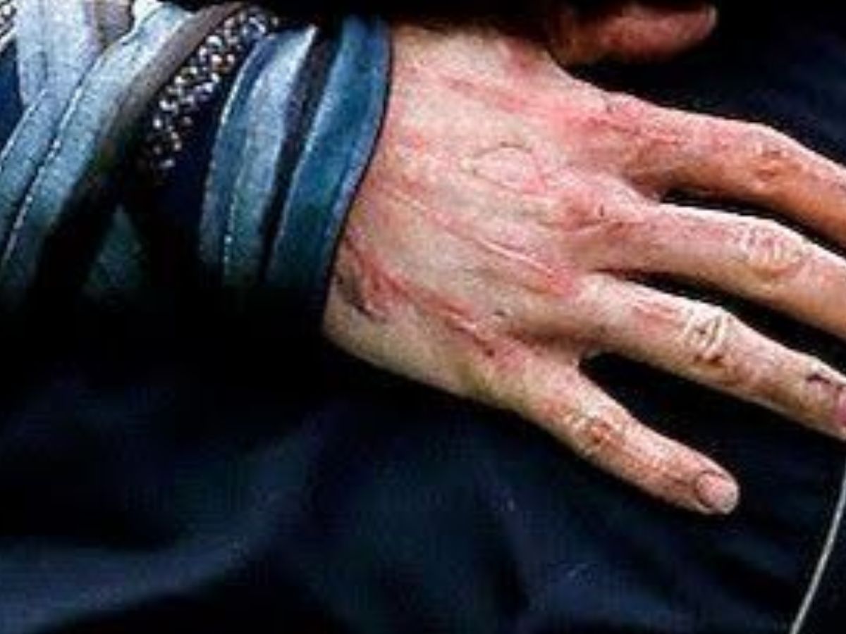 to cool an injury or burn - Photo Gallery