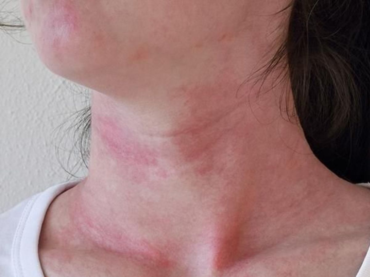 redness or warmth near the bone - Photo Gallery