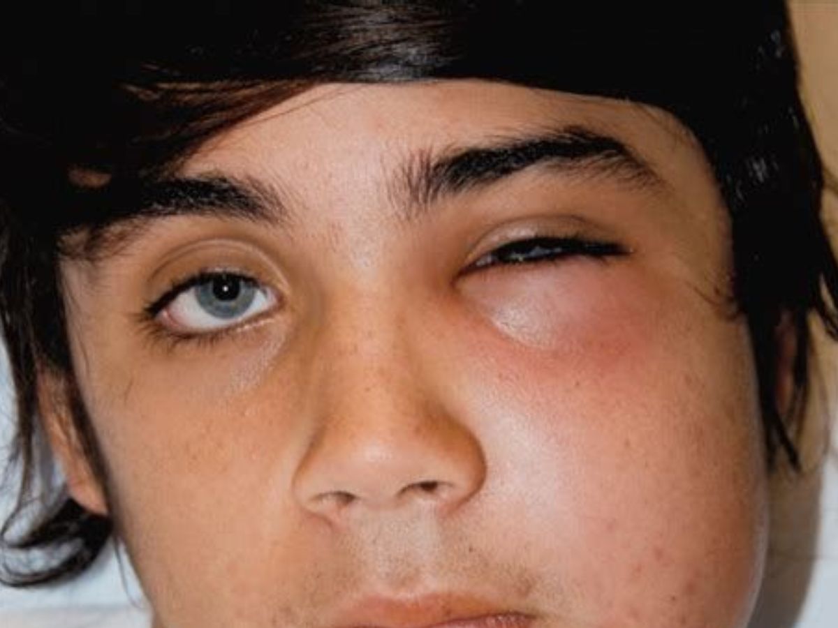 Cellulitis - Photo Gallery