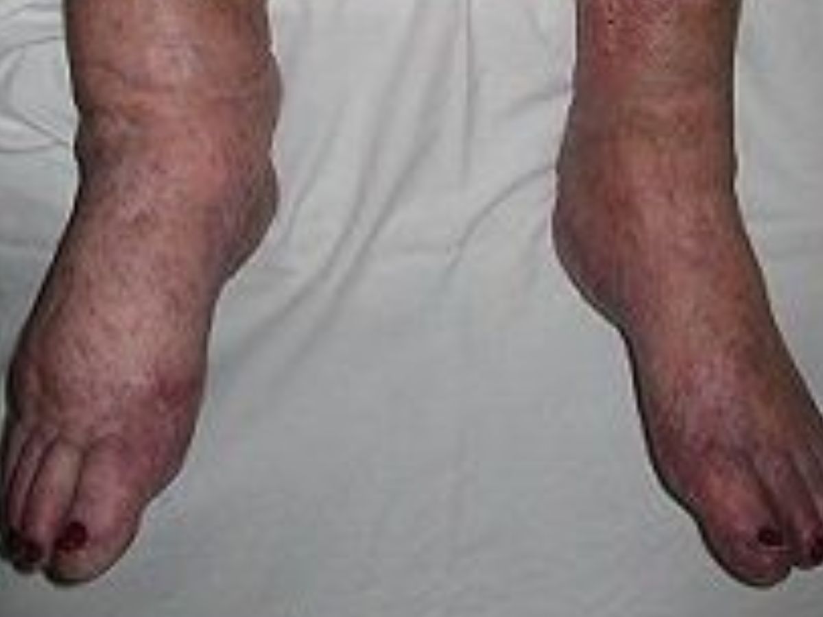 Tick-bite Induced Red Meat Allergy - Photo Gallery