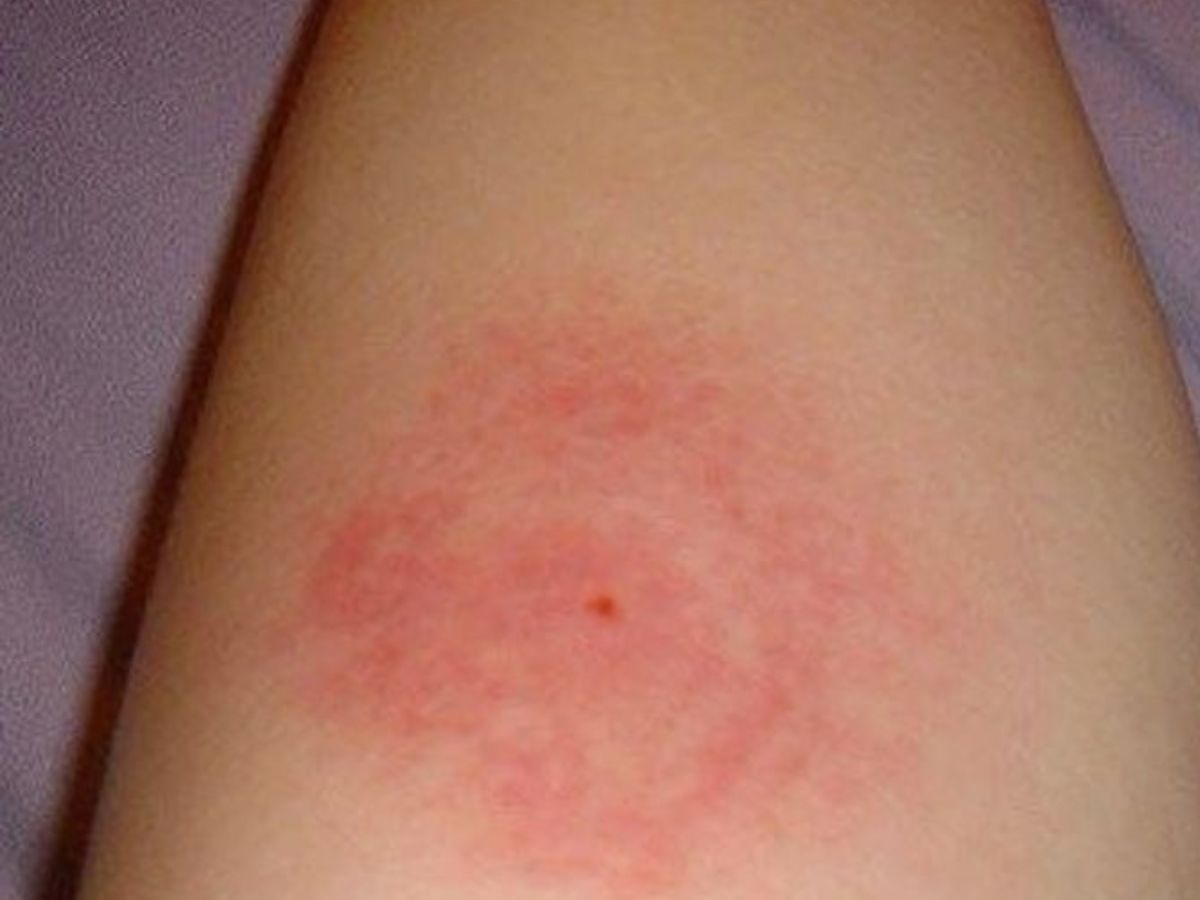 Skeeter Syndrome - Photo Gallery