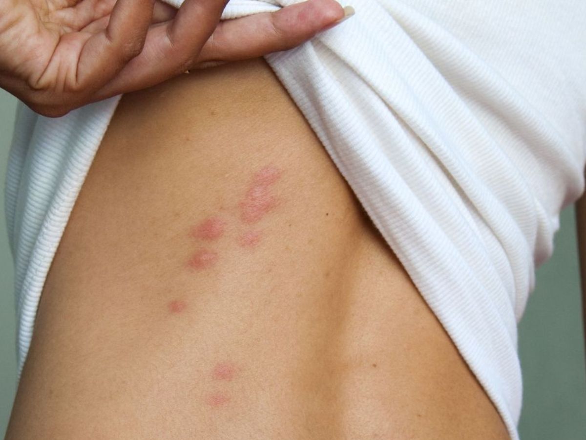 3Eosinophilic Cellulitis / Wells Syndrome - Photo Gallery