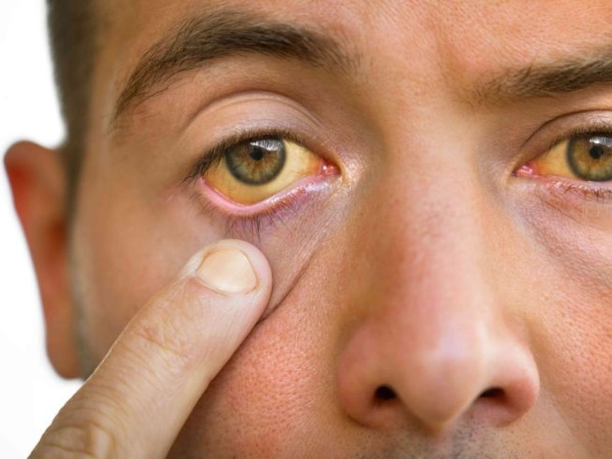 लिवर में चुपचाप जमा हो रहा है फैट! जानें 8 खतरनाक लक्षण जो शरीर पहले ही बता देता है - Photo Gallery