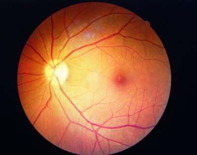 Diagnosis of retinopathy - Photo Gallery