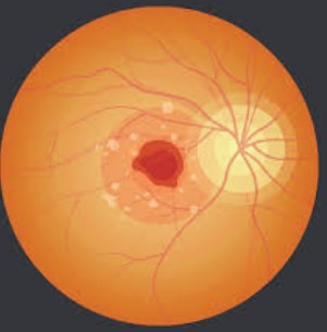 Macular Edema - Photo Gallery