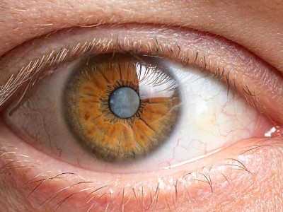 Cataract Risk - Photo Gallery