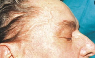 Giant Cell Arteritis - Photo Gallery