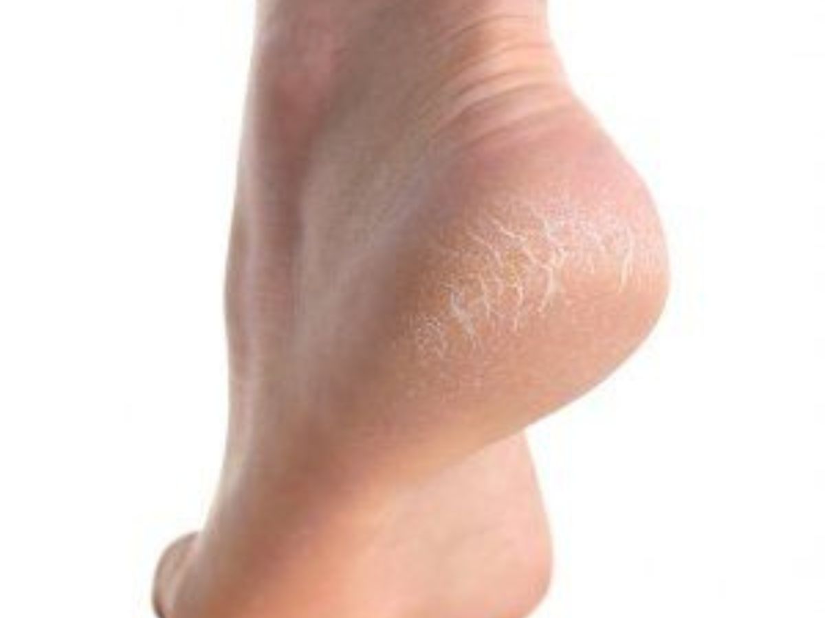 Cracked Heels Remedies At Home: फटी एड़ियों का इलाज घर पर ही! जानें सबसे असरदार घरेलू नुस्खे - Photo Gallery