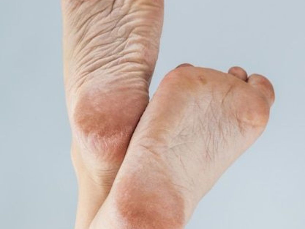 Cracked Heels Remedies At Home: फटी एड़ियों का इलाज घर पर ही! जानें सबसे असरदार घरेलू नुस्खे - Photo Gallery