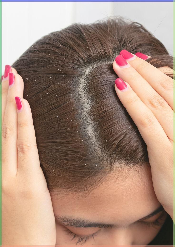 Home remedies for Dandruff:  सर्दियों में बालों में डैंड्रफ कर रही है परेशान, तो अपनाएं यह आसान घरेलू उपाय - Photo Gallery