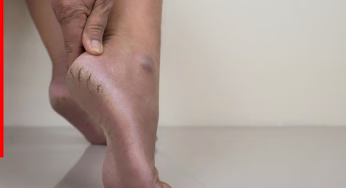 Cracked Heels Hacks: क्या सर्दियों में आप भी फटी एड़ियों की समस्या से परेशान हो जाती हैं? इसके लिए अपनाएं ये घरेलू नुस्खे