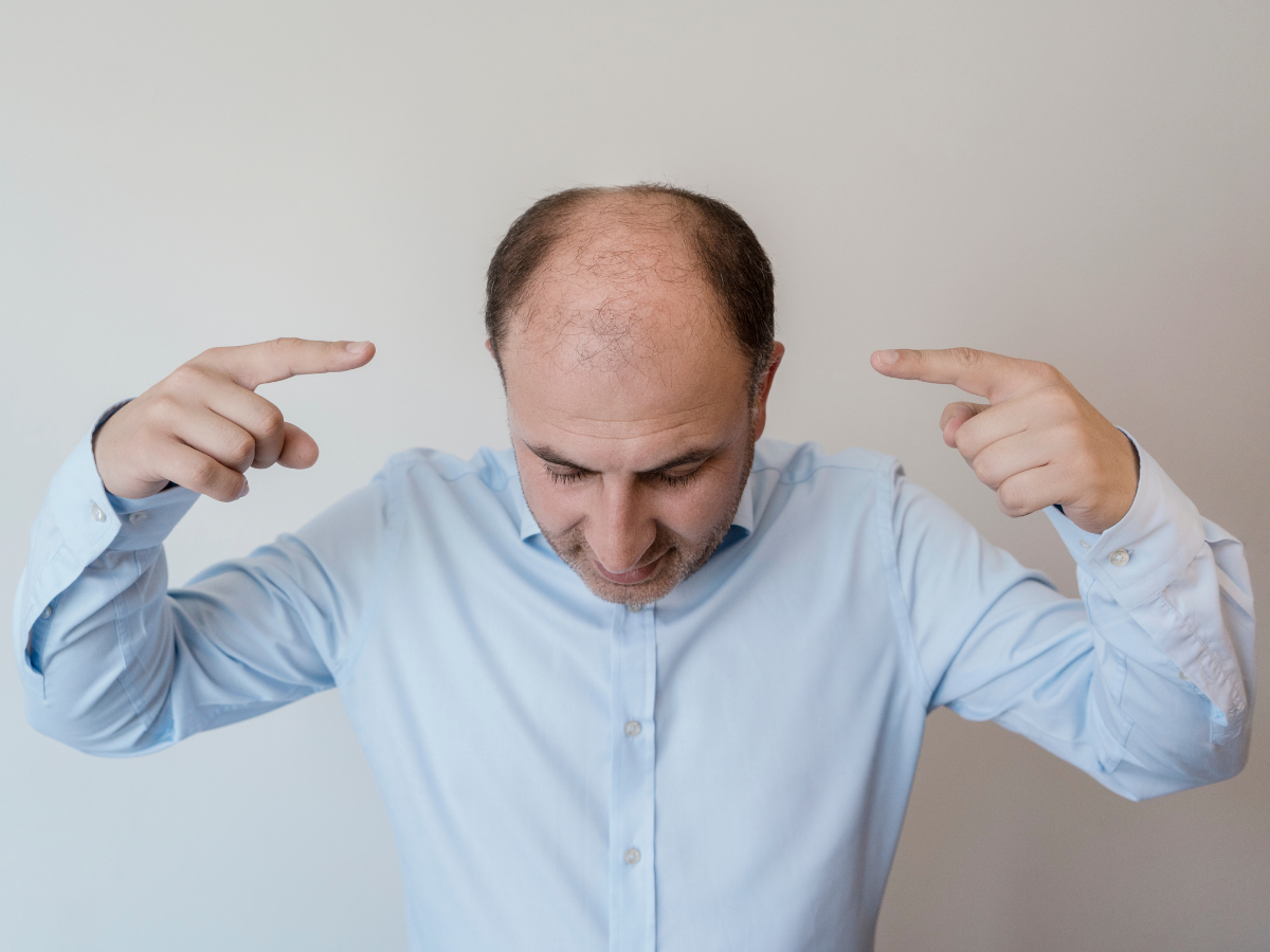 टॉप 10 सबसे ज़्यादा गंजे पुरुषों वाले देश, जानिए भारत की क्या है रैंकिंग? - Photo Gallery