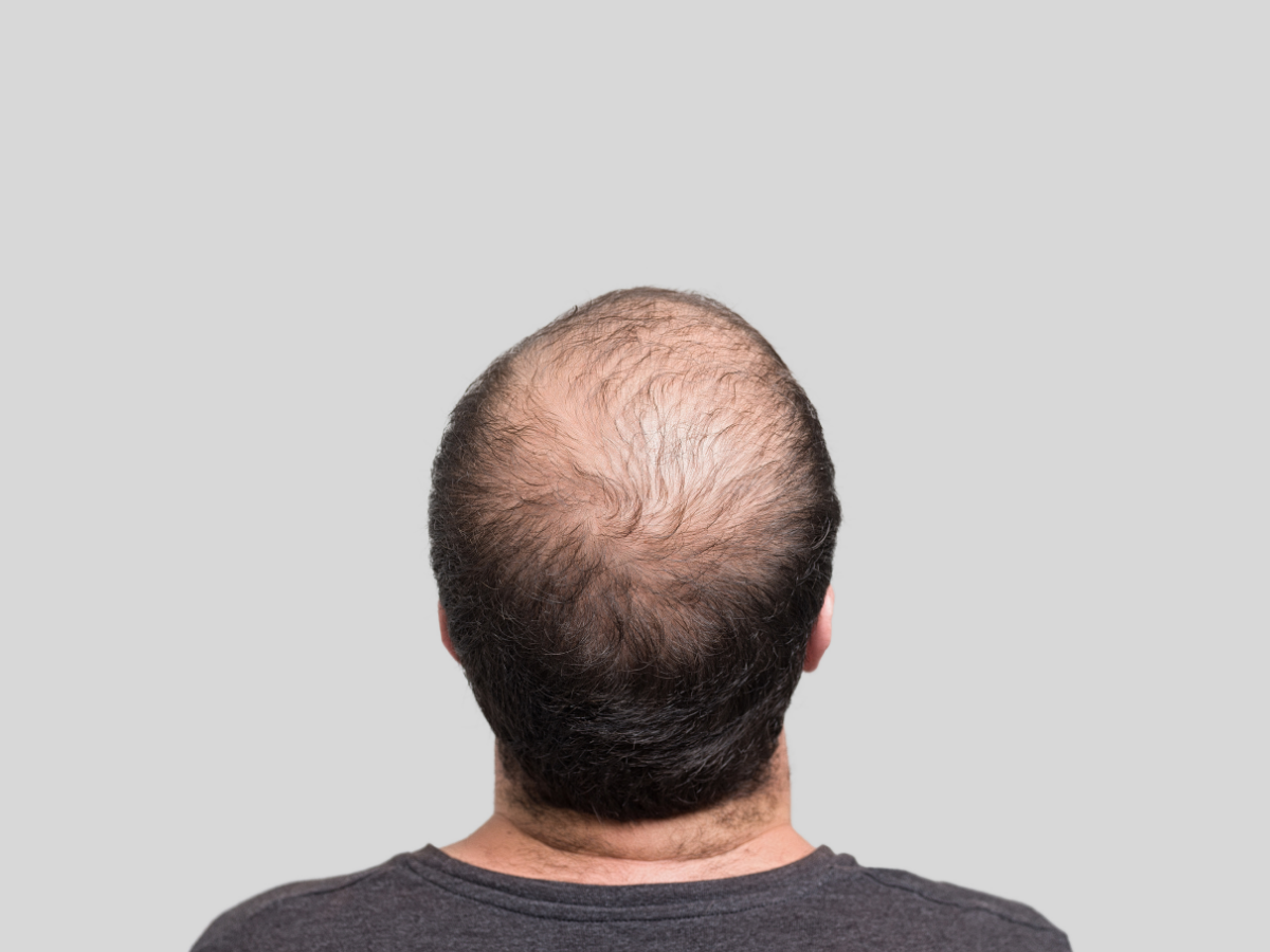 टॉप 10 सबसे ज़्यादा गंजे पुरुषों वाले देश, जानिए भारत की क्या है रैंकिंग? - Photo Gallery