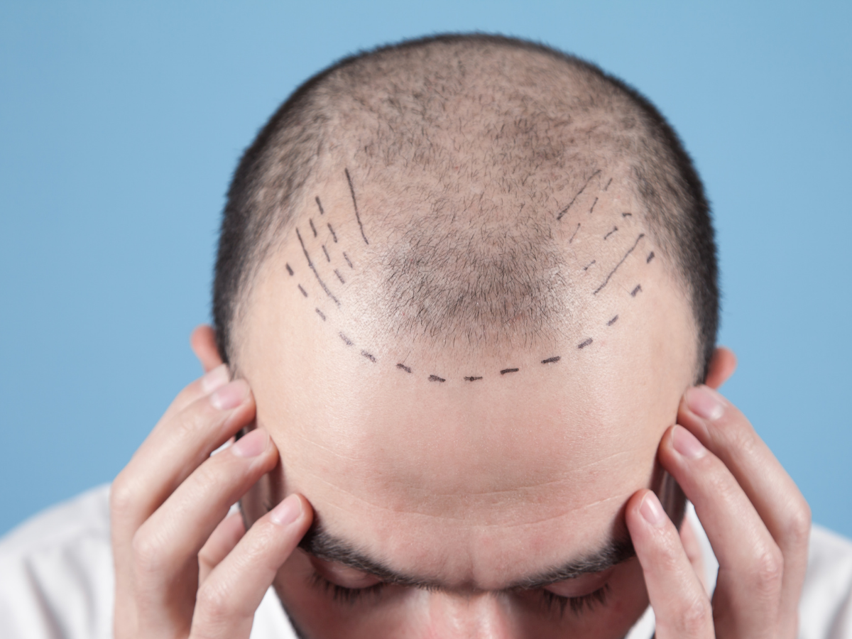 टॉप 10 सबसे ज़्यादा गंजे पुरुषों वाले देश, जानिए भारत की क्या है रैंकिंग? - Photo Gallery