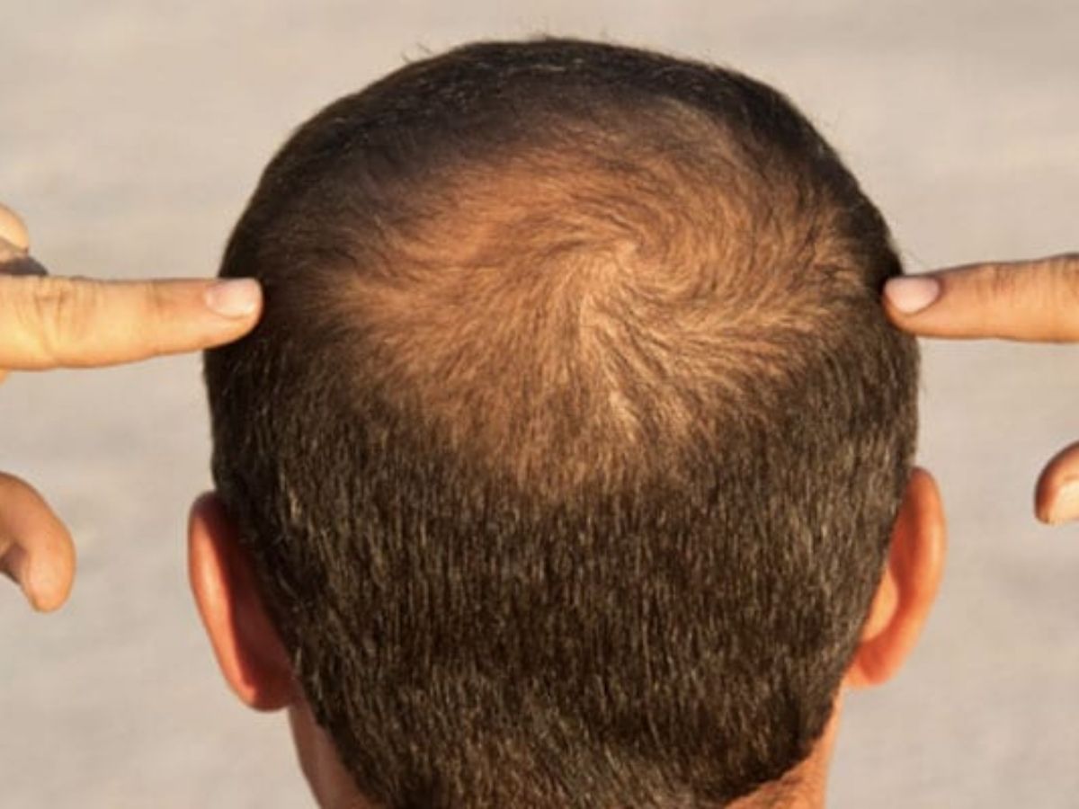 Baldness Hair growth rate increased by up to 539 - Photo Gallery