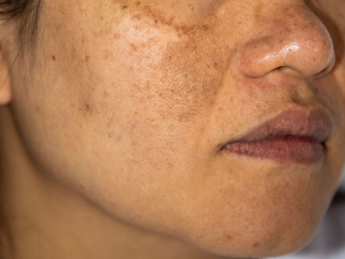 Damaging Skincare Habits: गलती से भी स्किन पर इन ट्रेंड्स को न करें फॉलों, नहीं तो खूब पड़ेगा पछताना; जानें डॉक्टर की सलाह - Photo Gallery