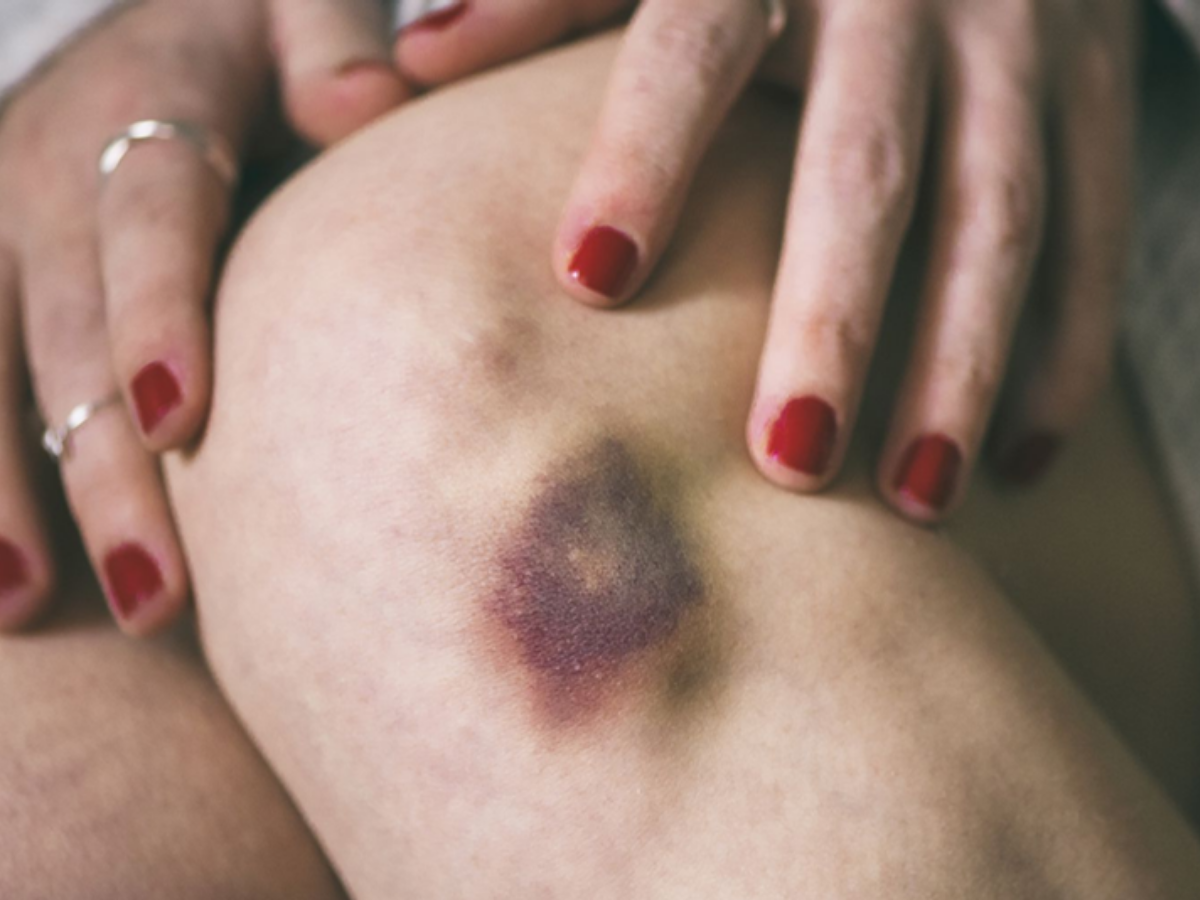 Blue marks for no reason - Photo Gallery