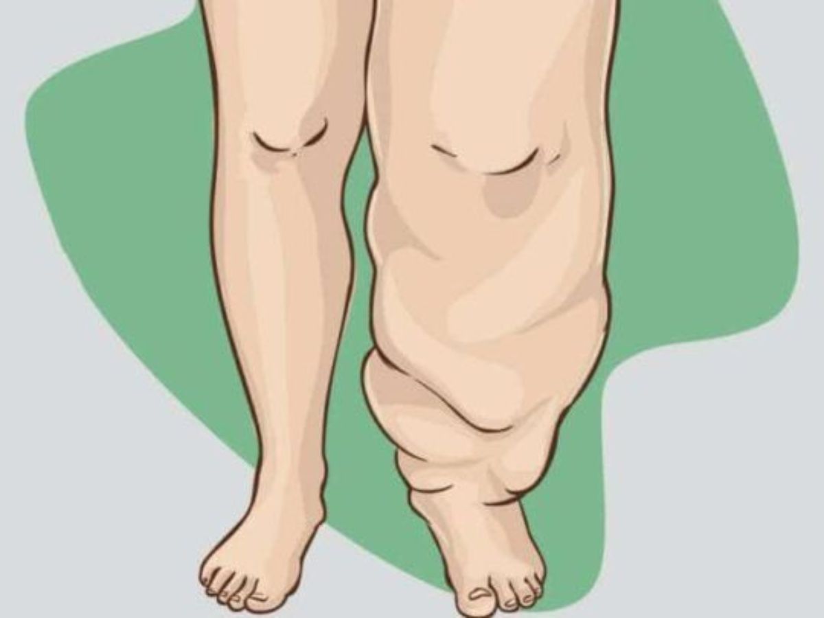 Elephantiasis Disease: मच्छरों के काटने से होता है हाथी पांव, जानें क्यों हाथी के जैसे हो जाते हैं पैर - Photo Gallery