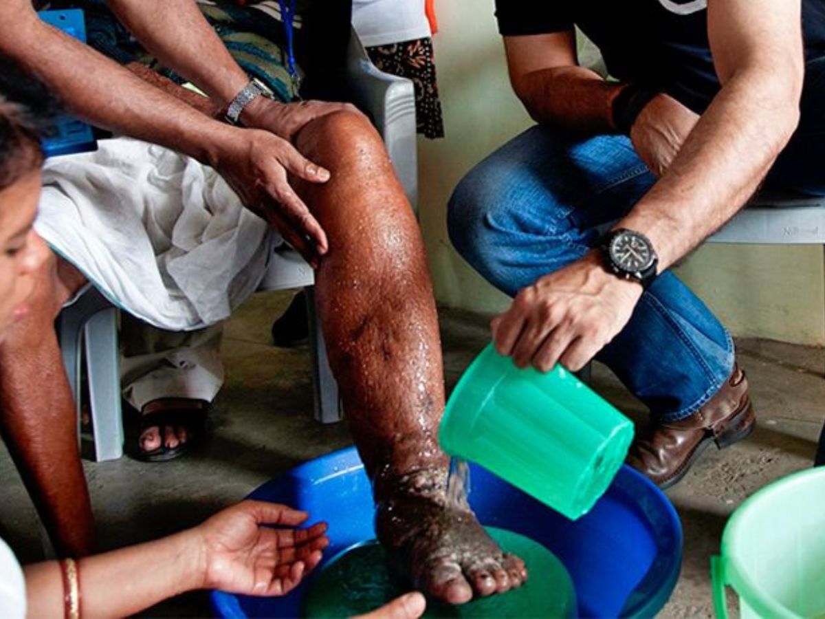 Elephantiasis Disease: मच्छरों के काटने से होता है हाथी पांव, जानें क्यों हाथी के जैसे हो जाते हैं पैर - Photo Gallery