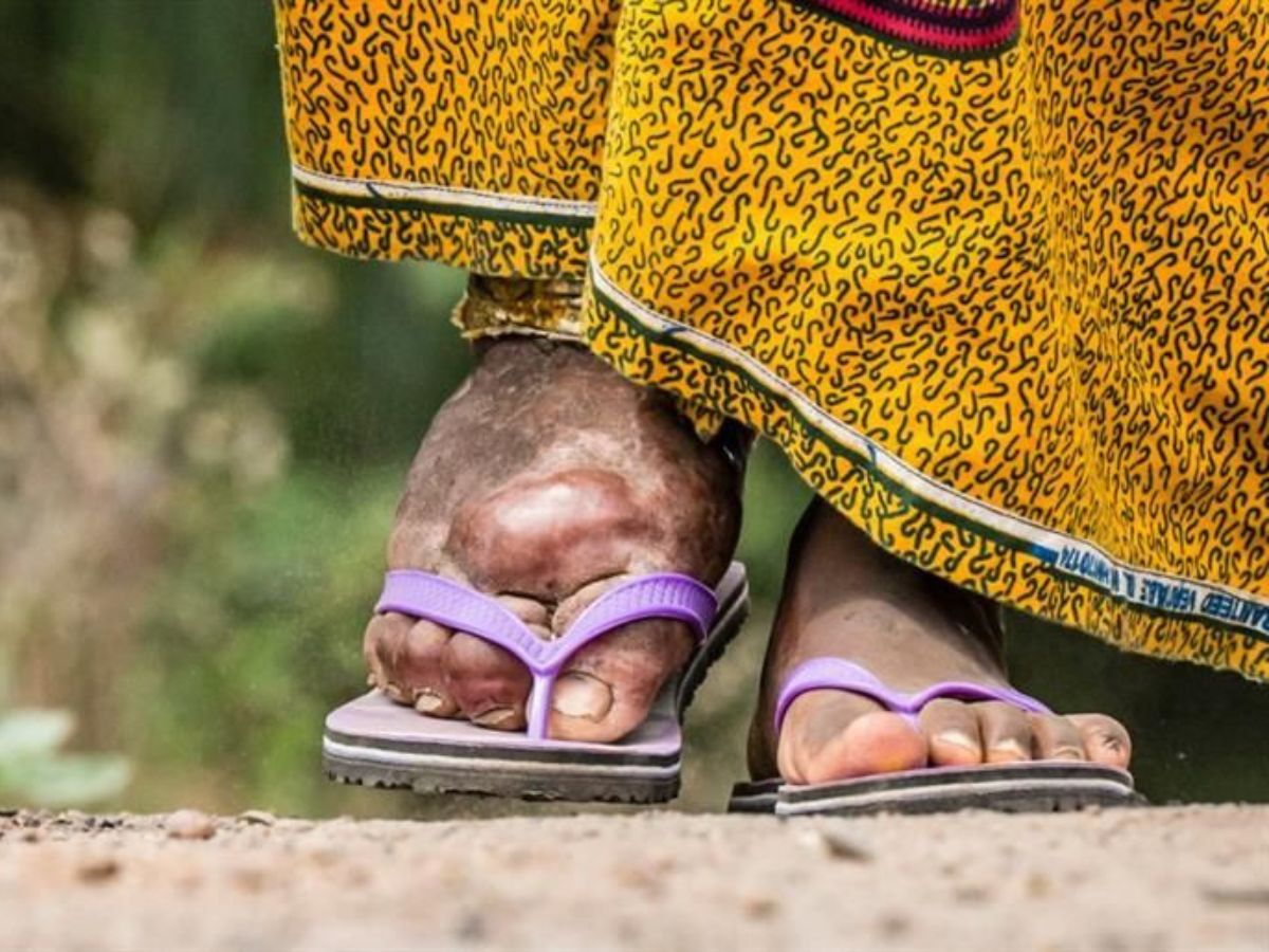 Elephantiasis Disease: मच्छरों के काटने से होता है हाथी पांव, जानें क्यों हाथी के जैसे हो जाते हैं पैर - Photo Gallery