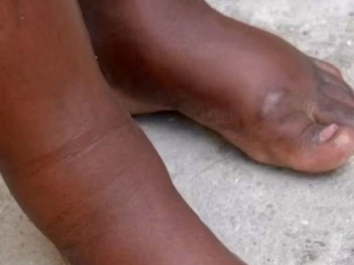Elephantiasis Disease: मच्छरों के काटने से होता है हाथी पांव, जानें क्यों हाथी के जैसे हो जाते हैं पैर - Photo Gallery