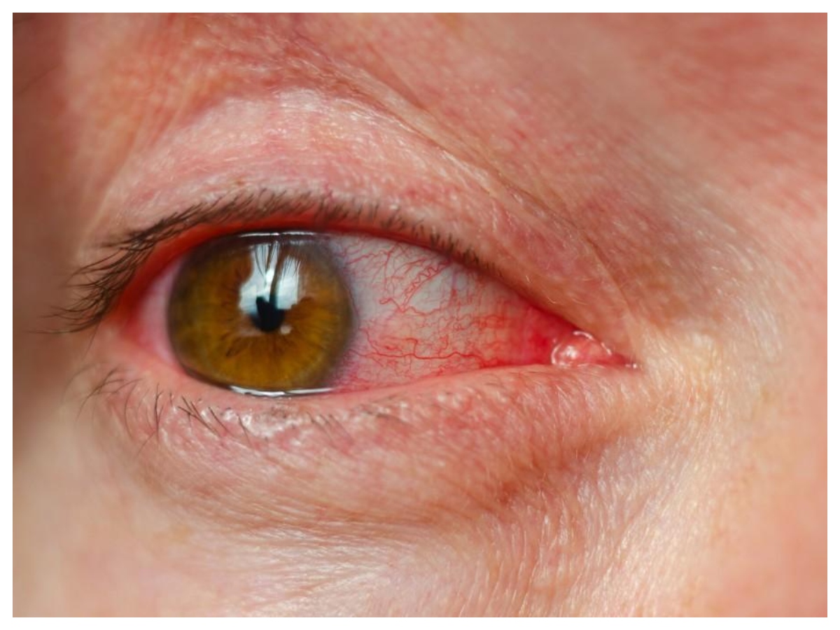 Redness in eyes: क्या आपकी आंखें दे रही हैं चेतावनी? जानें किस पोषक तत्व की है जरूरत - Photo Gallery