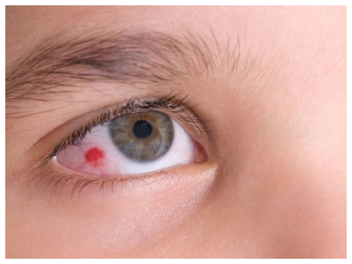 Redness in eyes: क्या आपकी आंखें दे रही हैं चेतावनी? जानें किस पोषक तत्व की है जरूरत - Photo Gallery