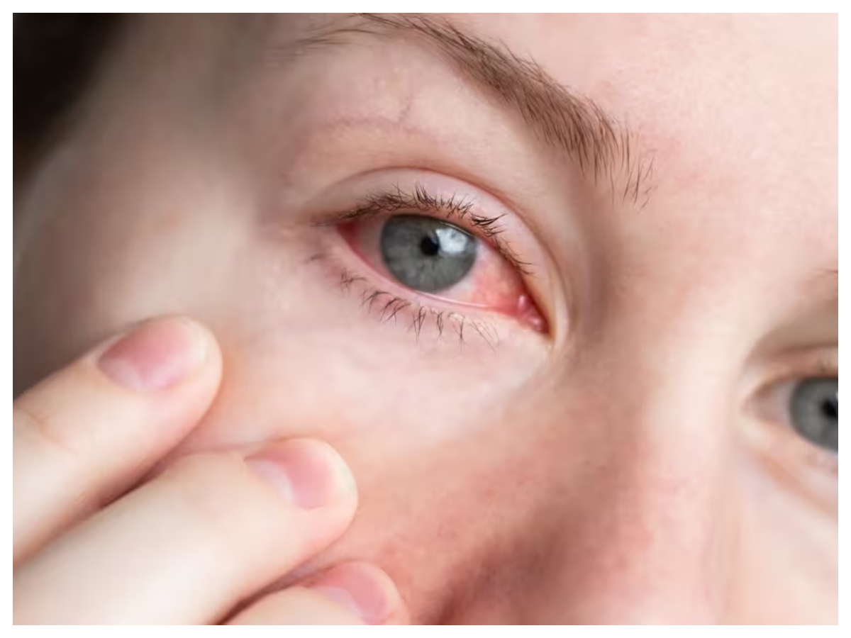 Redness in eyes: क्या आपकी आंखें दे रही हैं चेतावनी? जानें किस पोषक तत्व की है जरूरत - Photo Gallery
