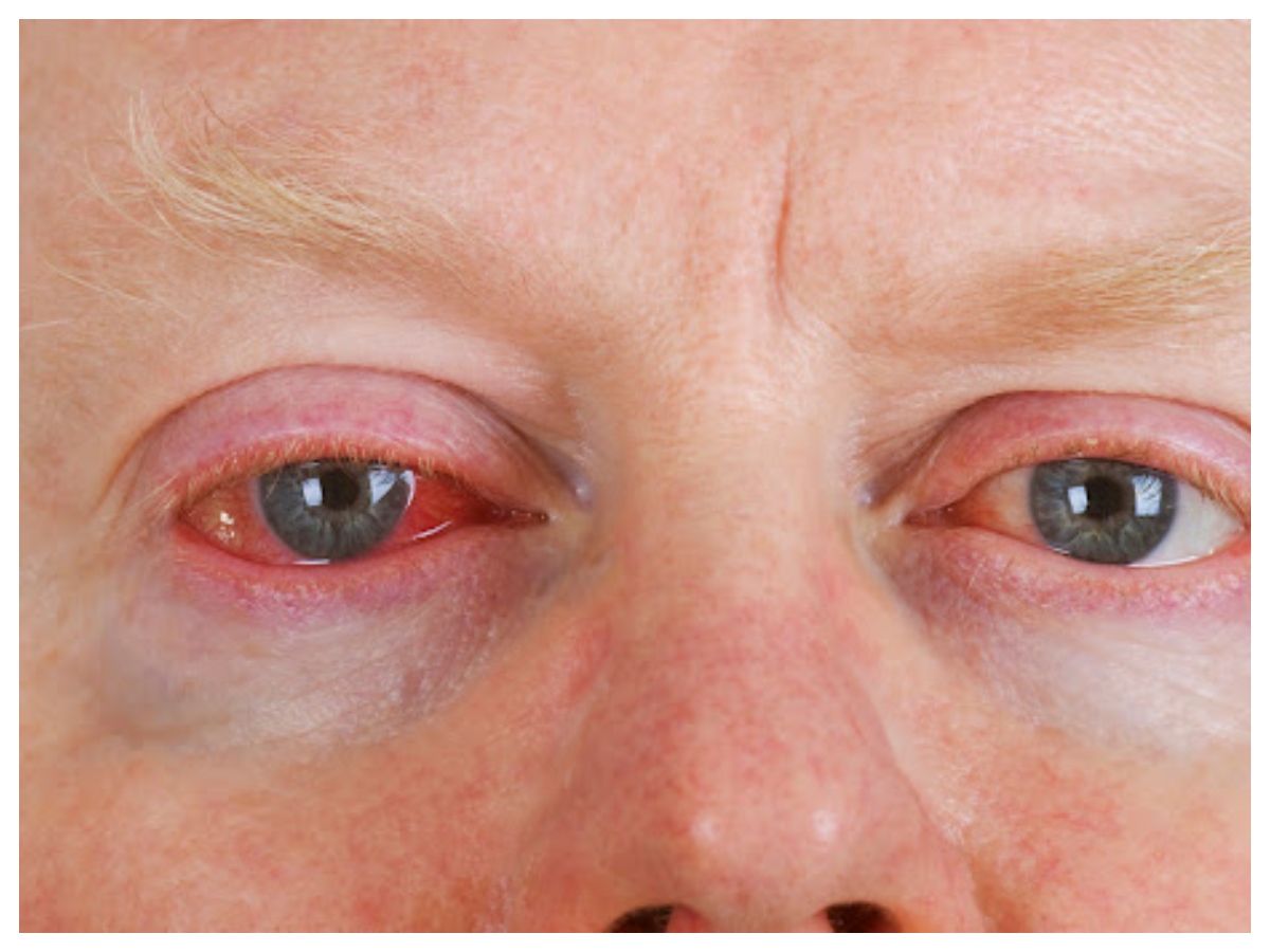 Redness in eyes: क्या आपकी आंखें दे रही हैं चेतावनी? जानें किस पोषक तत्व की है जरूरत - Photo Gallery