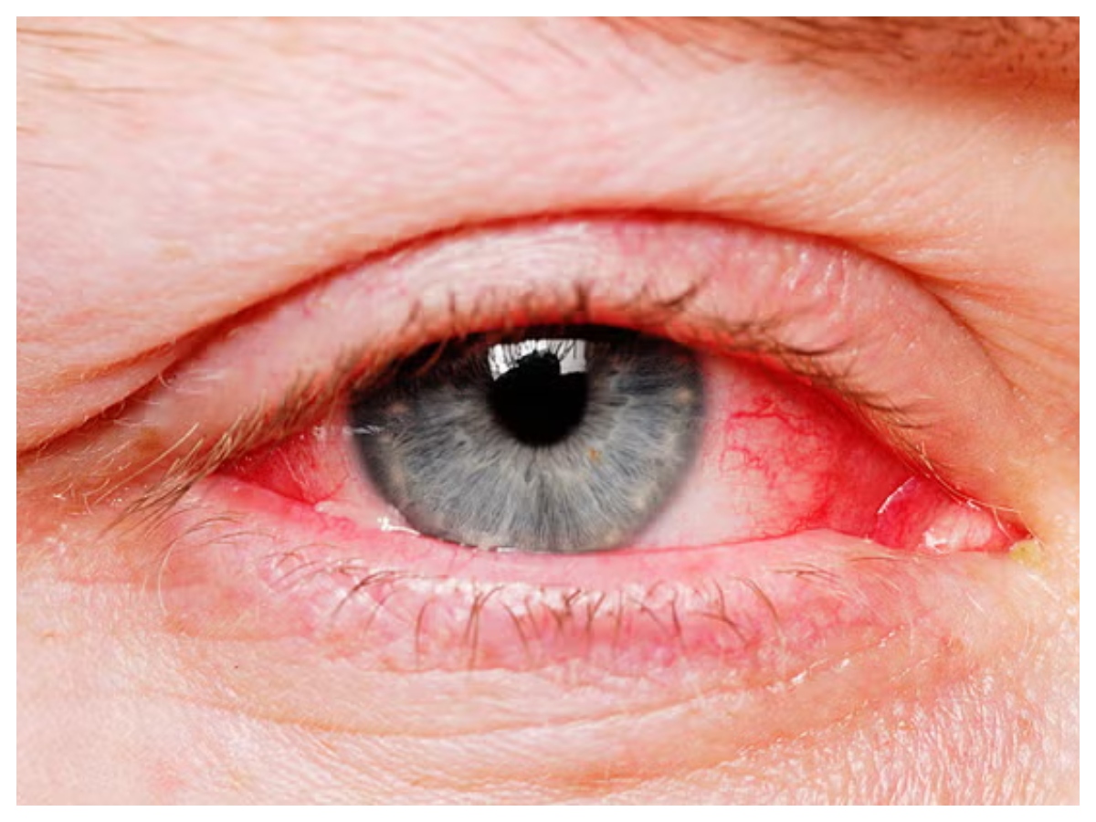 Redness in eyes: क्या आपकी आंखें दे रही हैं चेतावनी? जानें किस पोषक तत्व की है जरूरत - Photo Gallery