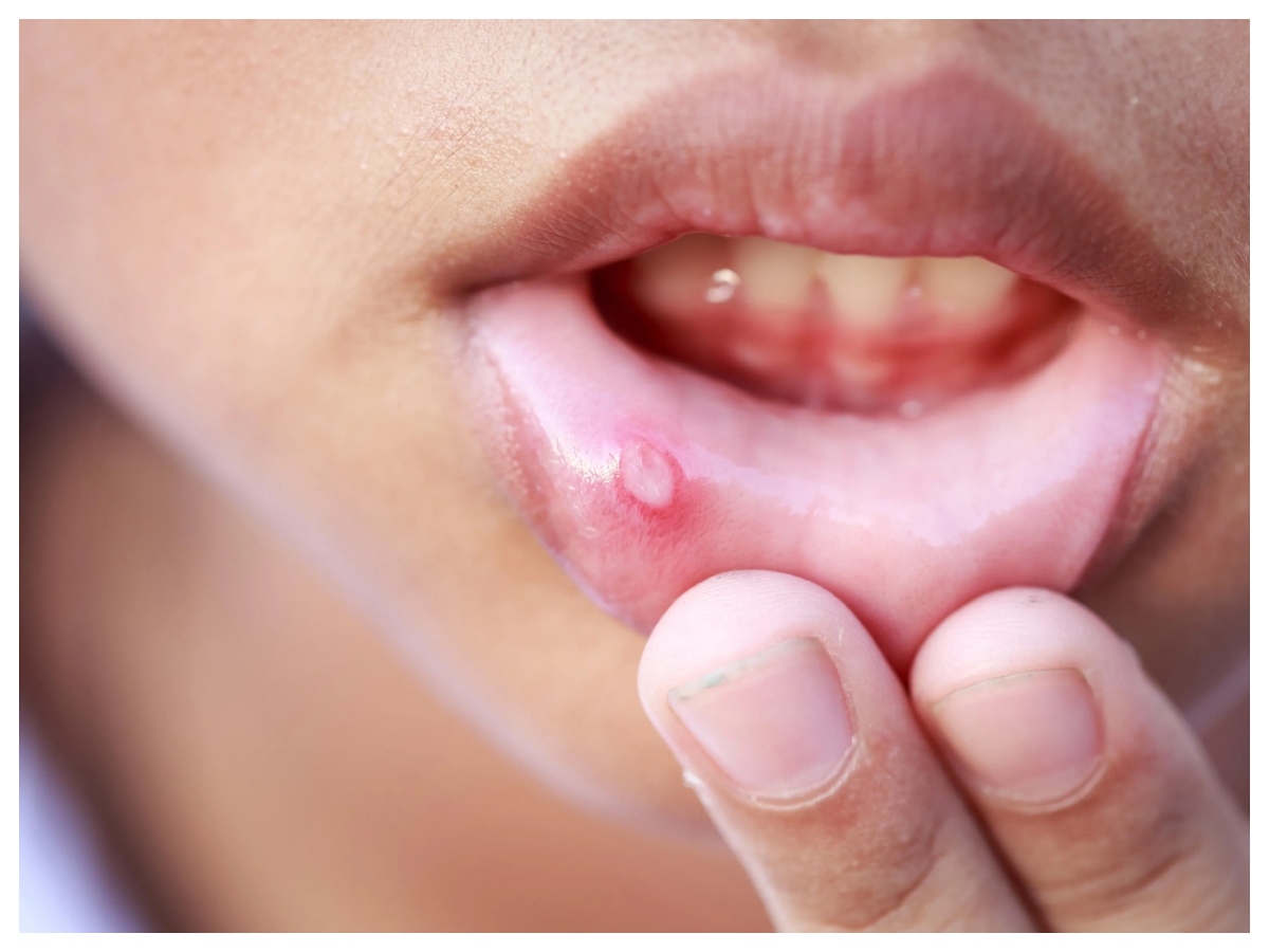 Mouth ulcers remedies: मुंह के छालों से कैसे पाएं राहत ? अपनाएं आसान घरेलू उपाय - Photo Gallery