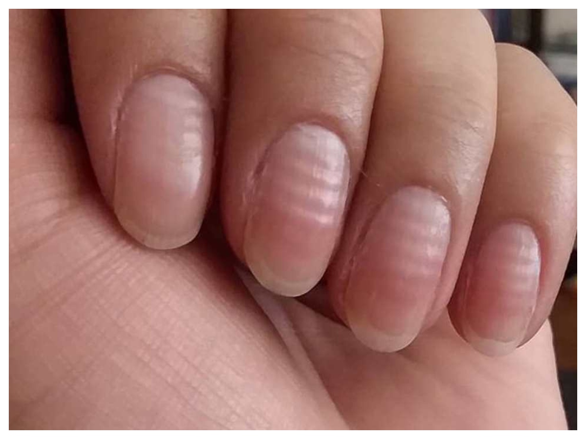 Nail health: नाखूनों में दिख रहे ये बदलाव? हो सकती है गंभीर बीमारी की चेतावनी - Photo Gallery